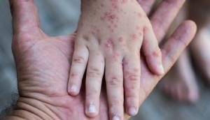 Data Dinas Kesehatan: Kasus Campak di Riau Capai 1.303 Suspek dalam 11 Pekan